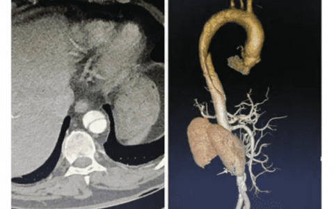 全球首款！浙大一院、阿里发布主动脉急诊AI模型：准确率高达99.4％