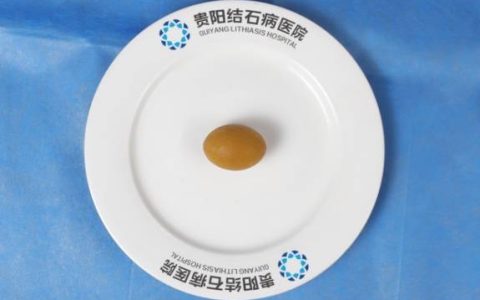 蜜蜡状胆囊结石现身贵阳，专家呼吁有这些习惯要警惕