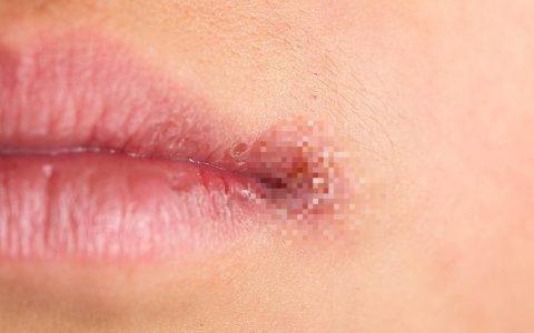 嘴角长了小水泡后，竟脑死亡！医生：不是简单的上火