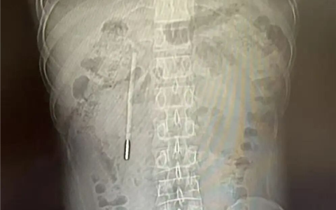 体内待了20年！男子12岁时误吞水银体温计 32岁因腹痛才取出